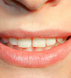 Junge Frau nach Zahnverlust - das Implantat ist der rechte Schneidezahn